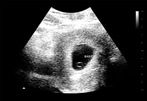 假怀孕5周b超图