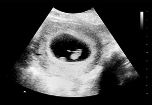 假怀孕6周b超图