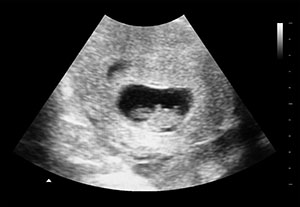 假怀孕7周b超图