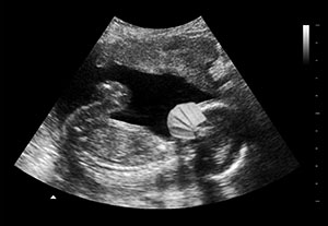 甲流防护超声恶搞单