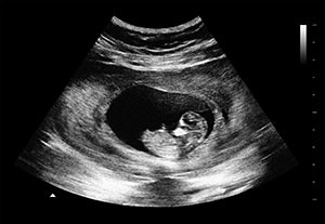 怀孕8周b超图片