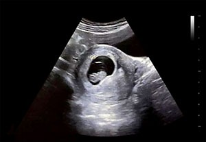 怀孕9周b超图片